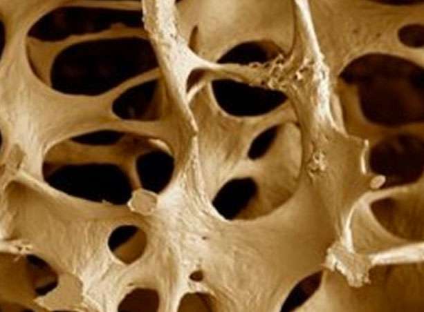 Traitement naturel de l'ostéoporose 